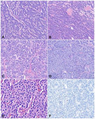 Neuroendocrine neoplasms of the thymus